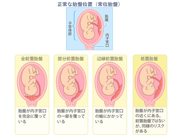 正常な胎盤位置と前置胎盤の種類